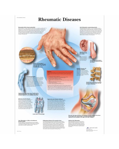 Rheumatic Diseases Chart
